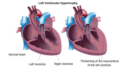 h lv|left ventricular hypertrophy causes.